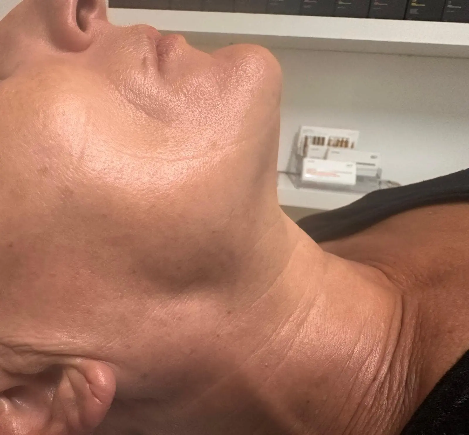Après HydraFacial