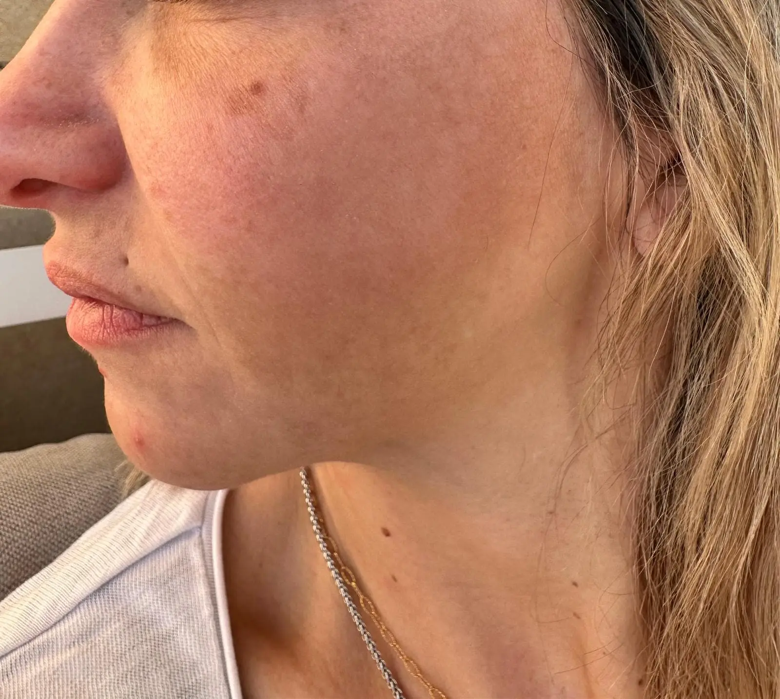 Après traitement Cosmelan