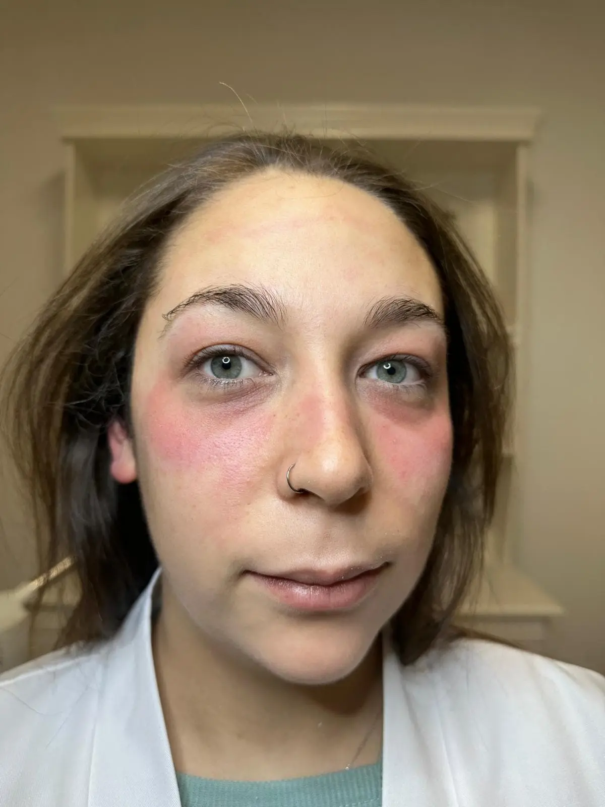 Après microneedling