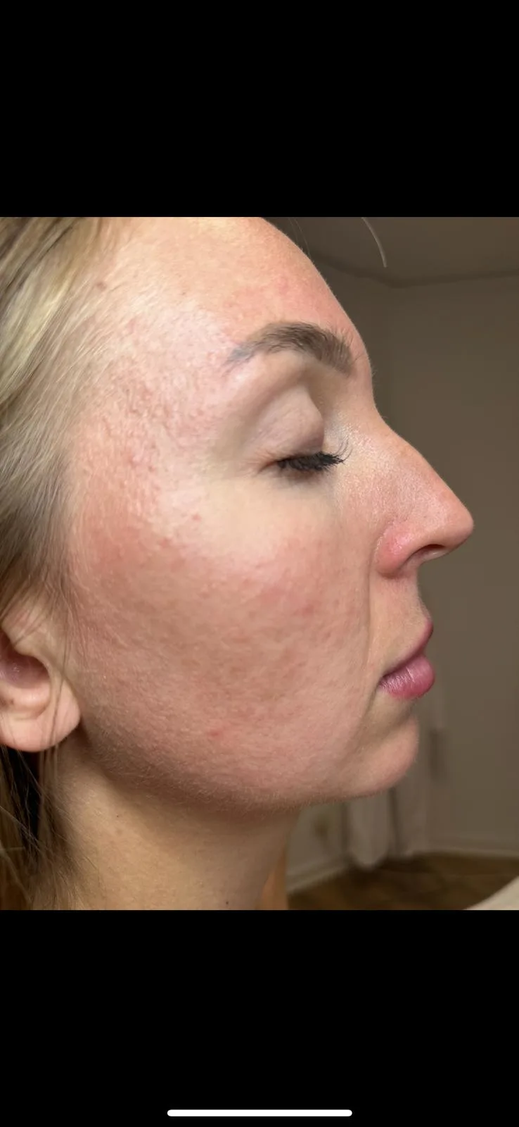 Après peeling chimique acné